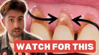 If Your Teeth Feel Sensitive, WATCH THIS!