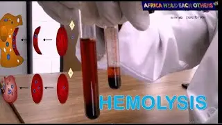 What is hemolysis? # what are the causes of hemolysis? Hemolysis experiment in vitro