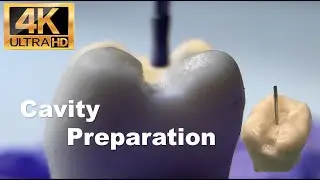 Magnified cavity preparation