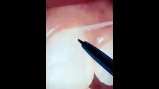 Why do dentists advise patients to floss?