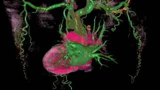 Collateral Flows in Patients with Aortic Coarctation