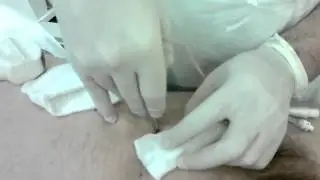 Цистостомия HD