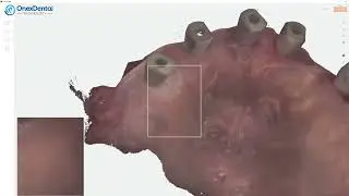 Heron IOS Üstçene implant üstü scan body (Maxilla)Taraması_2