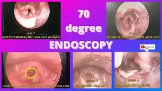 endoscopy of vocal cord paralysis | nodules | subglottic stenosis | supraglottic growth
