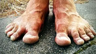 Correct the arched foot? What the orthopedist doesn't know.