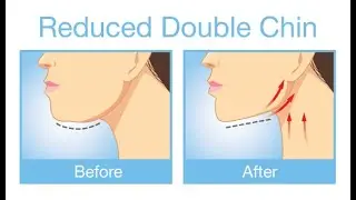 How to lose Chubby Cheeks | Make strong jawline | Get a Defined Face | To Get Rid Of A Double Chin