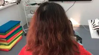 Пересадка волос. Подготовка донорской зоны у женщин.