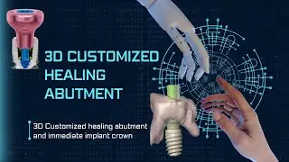 3D Customized healing abutment and immediate implant crown