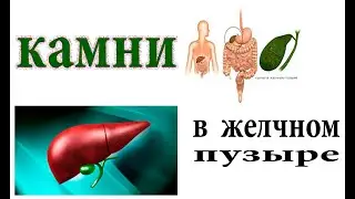Камни в желчном пузыре. Как лечить 