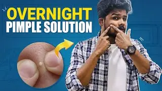 How To Get Rid Of PIMPLES OVERNIGHT | Simple Home Remedies | Men's Grooming In Telugu | TFV