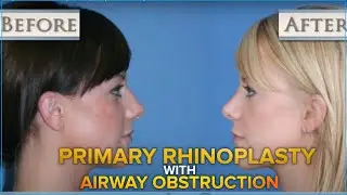 Dr. Jay Calvert - Primary Rhinoplasty with Airway Obstruction