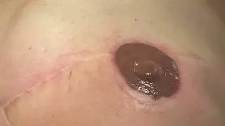 Nipple Reconstruction & Tattooing