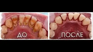 КАК ПРОСТО УДАЛИТЬ ЗУБНОЙ КАМЕНЬ