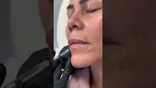 Upper and lower Lip Flip